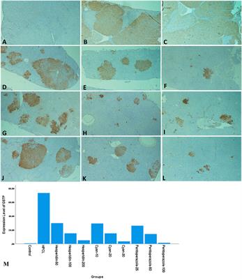 Integrating molecular, biochemical, and immunohistochemical features as predictors of hepatocellular carcinoma drug response using machine-learning algorithms